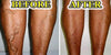Ultimate Varicose Veins Treatment Cream