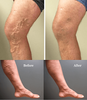 Ultimate Varicose Veins Treatment Cream