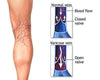 Ultimate Varicose Veins Treatment Cream