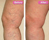 Ultimate Varicose Veins Treatment Cream