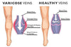 Ultimate Varicose Veins Treatment Cream