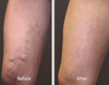 Ultimate Varicose Veins Treatment Cream